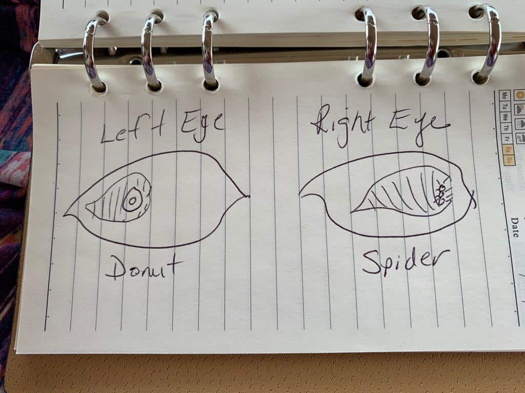 A SPIDER IS BORN! Sudden Vitreous Detachment in Eyeball #2