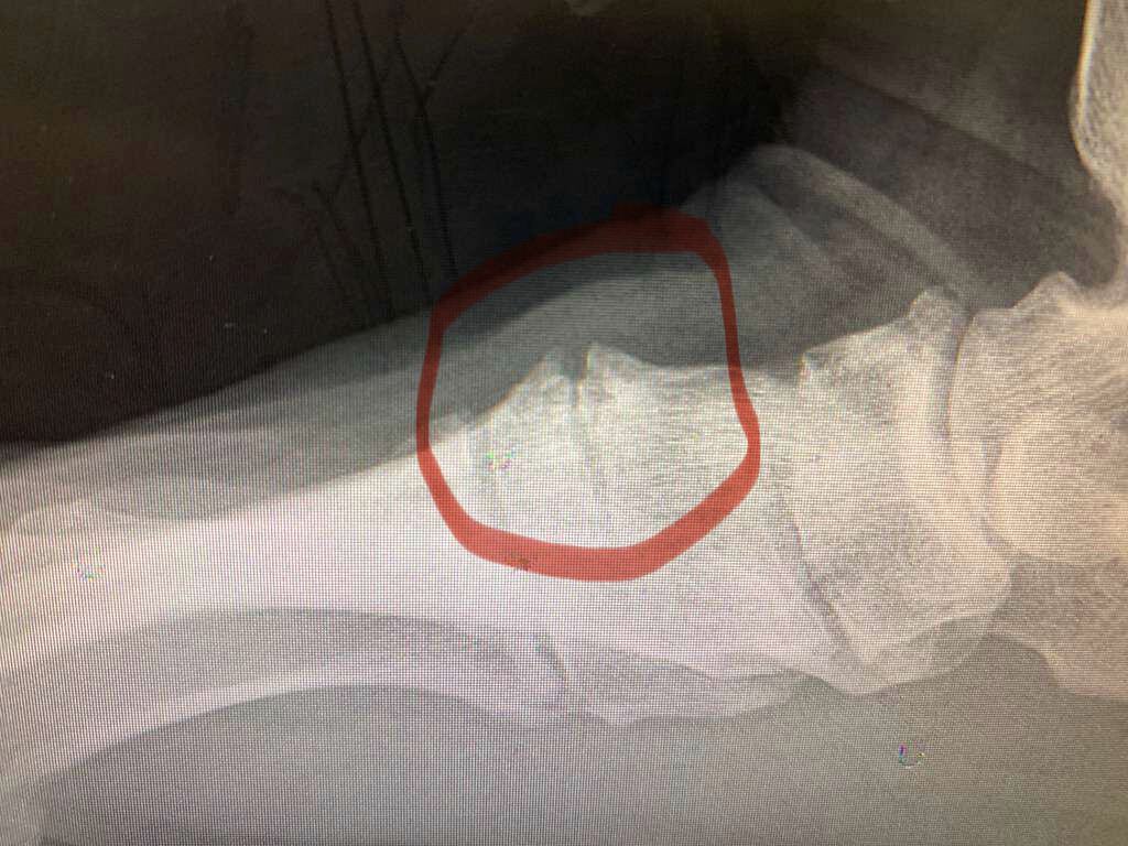Surprise Diagnosis After I Hurt My Foot Fending Off a Rooster Attack!